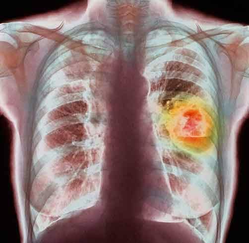 Proliferazione di cellule tumorali all'interno di un polmone.