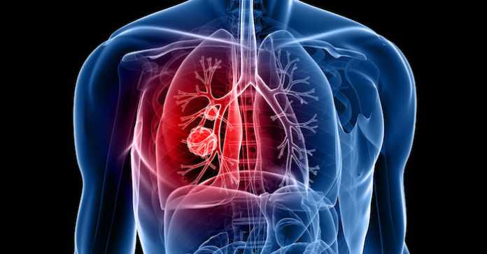 La cannabis aiuta nella cura del cancro ai polmoni