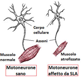 Differenze tra motoneurone sano e motoneurone affetto da SLA